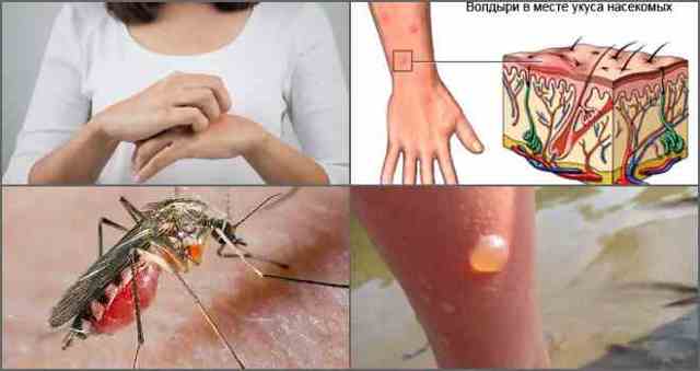Аллергическая реакция на укус комара