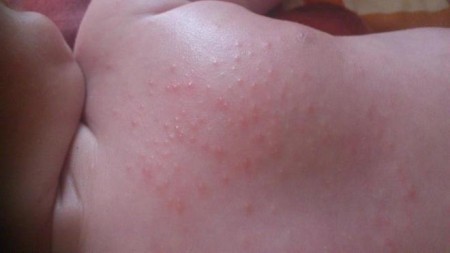 Аллергия на аквадетрим у грудничков