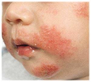 Аллергия на клещей домашней пыли