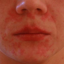 Пищевая аллергия на коже