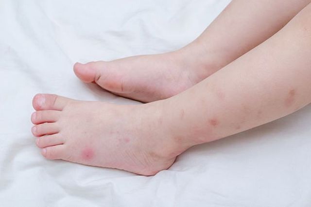 Аллергия как укус комара