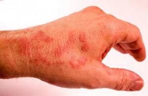 Аллергия чешутся руки