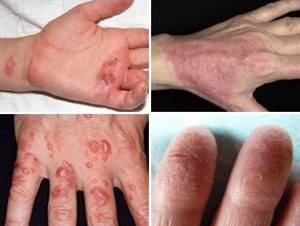 Дерматит на пальцах рук лечение