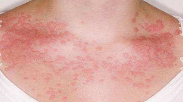 Аллергия на сладкое у взрослых лечение