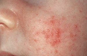 Аллергия при гв