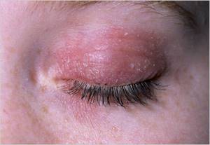 Аллергия на помаду лечение