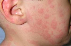Пищевая аллергия на коже