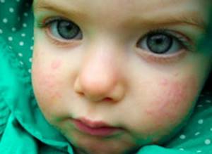 Как проявляется аллергия на лице
