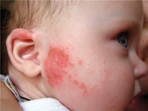 Аллергия на вигантол