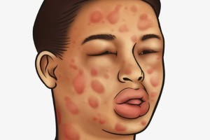 Аллергия на перо подушки симптомы