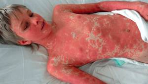 Аллергия с температурой у взрослого