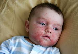 Аллергия на пот у ребенка