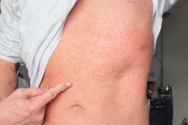 Аллергия на коже тела