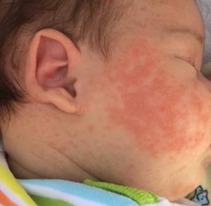 Аллергия у новорожденного чем лечить