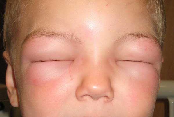 Аллергия век