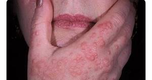 Бактериальный дерматит у человека