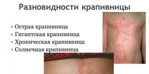 Аллергия по типу крапивницы лечение