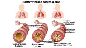 У ребенка аллергия на домашнюю пыль