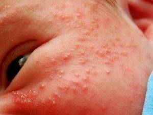 Как может выглядеть аллергия