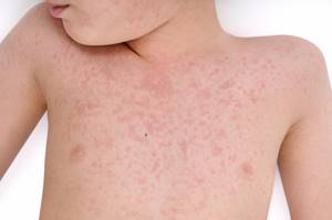 Аллергия на рисовую кашу у грудничка