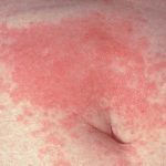 Аллергия на солярий симптомы