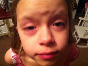 Аллергия на мяту у детей