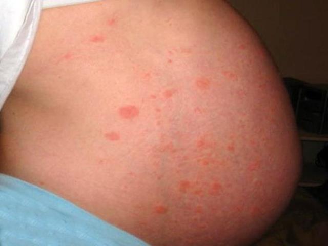 Аллергия у беременных симптомы