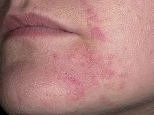 Циновит крем от аллергических проявлений на коже