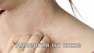Аллергические проявления на коже
