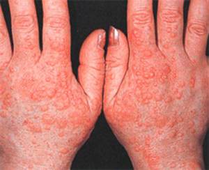 Аллергия чешутся руки