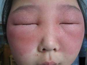 Как проявляется аллергия на лице