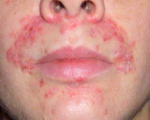 Лечение контактного дерматита на лице