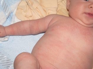 Аллергия на ладошках у ребенка