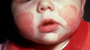 Аллергия у ребенка 5 лет
