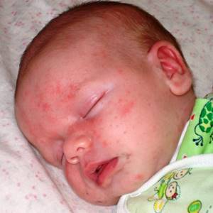 Аллергия на животных у новорожденных