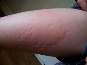Аллергия на солнце симптомы лечение