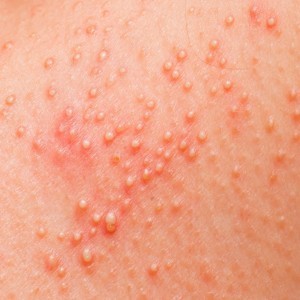Токсико аллергический дерматит у детей