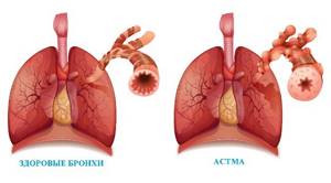 Аллергическая астма у детей