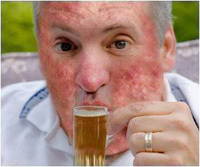 Как избавиться от аллергии на алкоголь