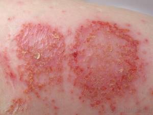 Признаки аллергии на коже