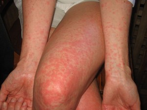 Кожная аллергия лечение