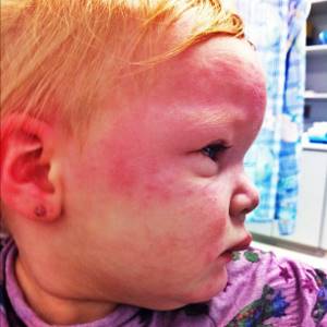 Анафилактический шок симптомы у детей