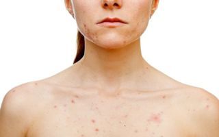 Аллергия покраснение кожи