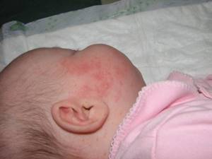 Аллергия на творог агуша у ребенка