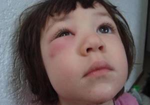 Отек глаз при аллергии у ребенка