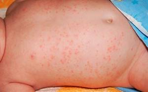 Аллергия у ребенка сыпь