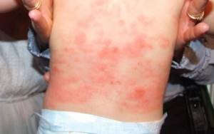 Аллергия на порошок у детей