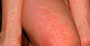 Недорогая мазь от аллергии на коже