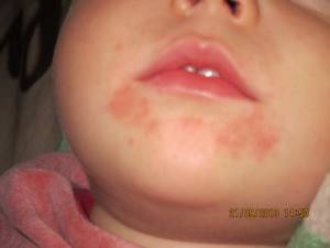 Аллергия на подбородке
