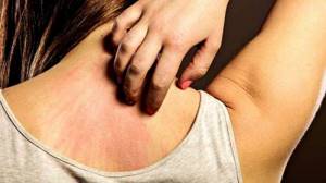 Аллергия на кефир у взрослых симптомы